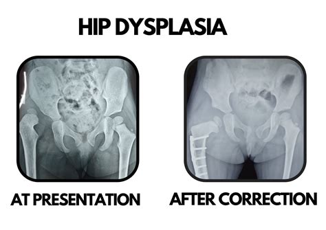 Hip Dysplasia And Preservation Dr Deepak Khurana Paediatric