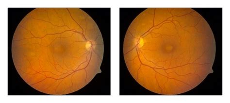 Color Fundus Photographs A And Oct B Of The Right And Left Eyes On