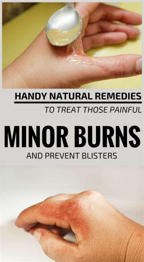 Minor Burn Blister Treatment Prnso