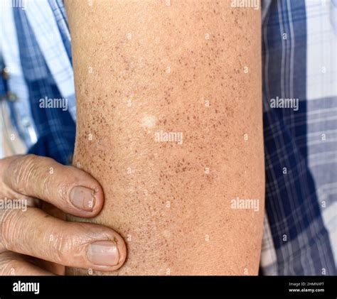 Age Spots And White Patches On Arm Of Asian Elder Man Age Spots Are