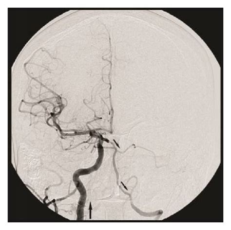 A Lateral Right Subclavian Artery Angiogram Cranial View