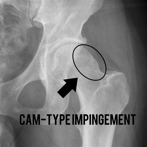 Femoroacetabular Impingement A Guide To Diagnosis In Primary Care