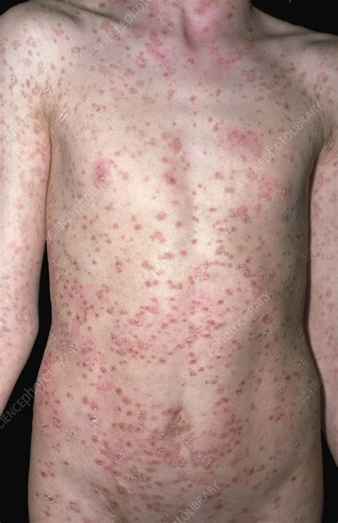 Guttate Psoriasis Stock Image C Science Photo Library