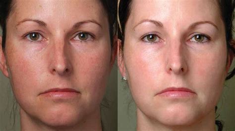 Before And After Ipl Photofacial Cosmetic Surgery Ipl Photofacial