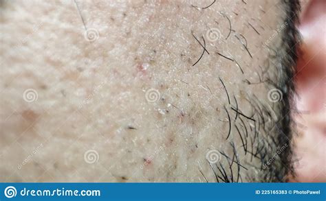 Closeup Of Caucasian Skin With Ingrown Hair And Man Short Beard Close