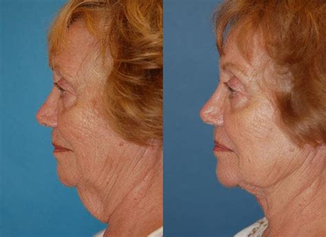 Laser Assisted Weekend Neck Lift In Central Florida