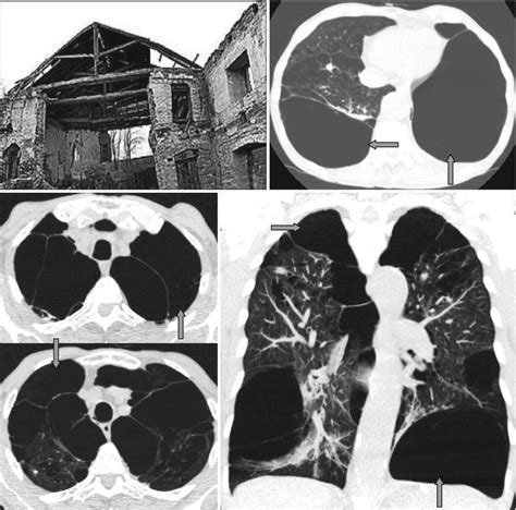 Lung Radiology Key