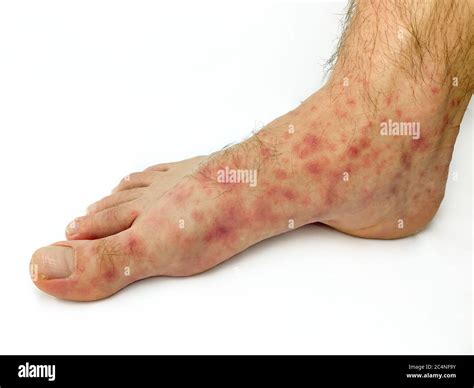 Close Up Of Males Foot And Toes With Red Rash Desease Isolated On A
