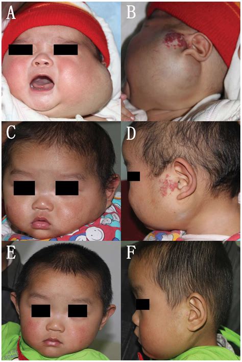 Treatment With Propranolol For Infantile Hemangiomas A Case Series Of