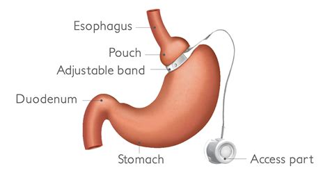 Adjustable Gastric Banding Weight Loss Surgery In Ahmadabad Asian