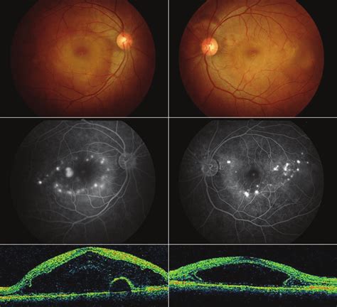Fundus Photography Fluorescein Angiography Fag And Optical Coherence