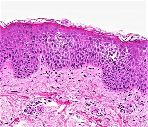 Eczematous Dermatitis Histopathology