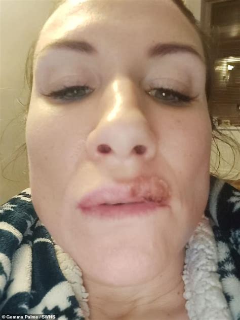Mother Reveals Dodgy £180 Fillers Made Her Mouth Fill With Blisters