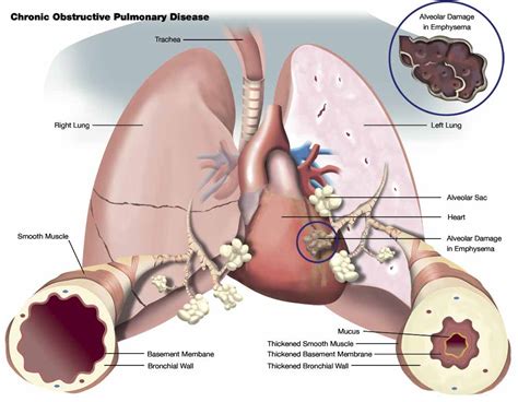 Chronic Obstructive Pulmonary Disease Graphic Design Photorealistic CGI Information Graphics