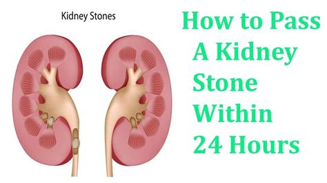 What Can Help Pass A Kidney Stone