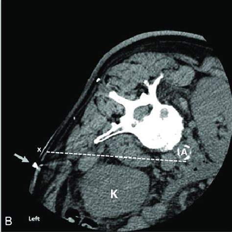 A Computed Tomography Ct Scout View B Axial Ct Image Shows The