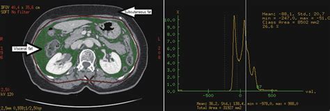 Measurements Of Abdominal Fat From A Ct Image A Visceral Adipose