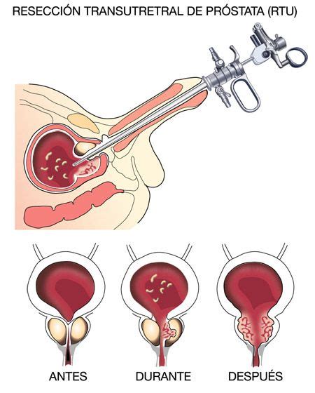 Resección transuretral de próstata Centro Gil Vernet de Urología