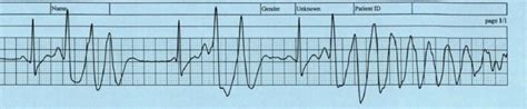 A Case Report Of Torsade De Pointes And Brugada Pattern Associated With