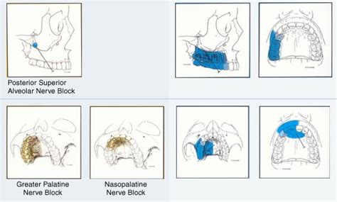 Psa Greater Palatine And Nasopalatine Nerve Blocks Landmarks Are