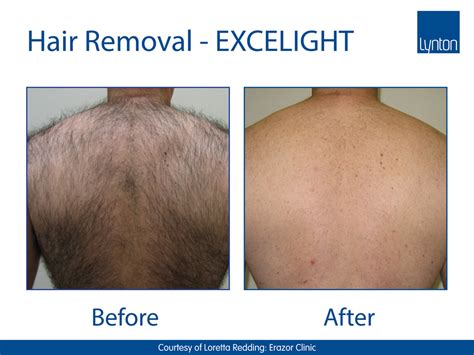 Permanent Hair Reduction Jh Skincare Clinic Ipl Laser And Dermalux