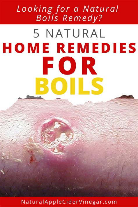 5 Natural Home Remedies For Boils All Natural Home Natural Home