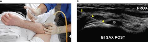 Sonographically Guided Distal Biceps Tendon Injections Sellon 2014