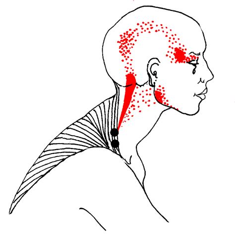 Chronic Trigger Point Pain Trapezius And Neck Rchronicpain