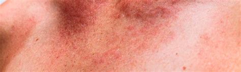 Types Of Heat Rash Heat Rash Types Of Skin Rashes Rashes Images
