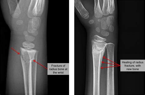 Buckle Fracture Raleigh Hand Surgery — Joseph J Schreiber Md