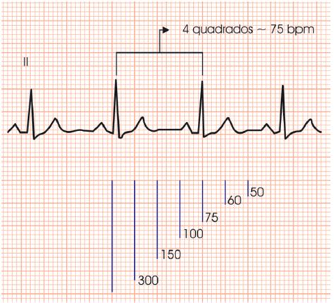 Como Calcular A Frequência Cardíaca Pelo Eletrocardiograma Ecg