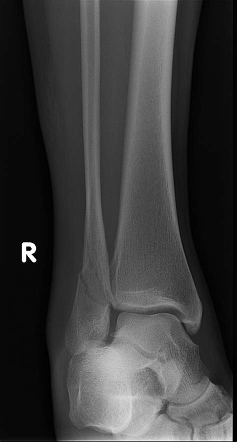 Ankle Fracture Weber B Image