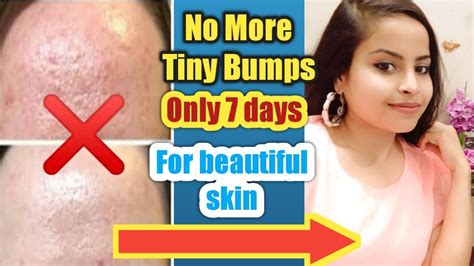 7 Days Challange L Get Rid Of Tiny Bumps On Face At Home L Treat