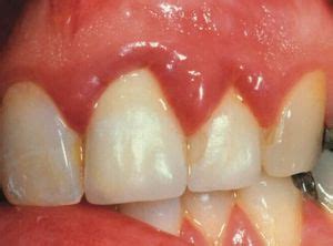 Zahnfleisch Geschwollen Nahe Dem Zahn Ursachen Und Was Zu Tun Ist