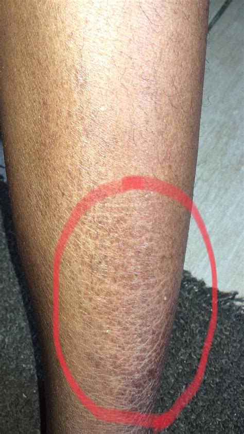 Skin Concern Need Help With My Extremely Dry Legs Rskincareaddiction