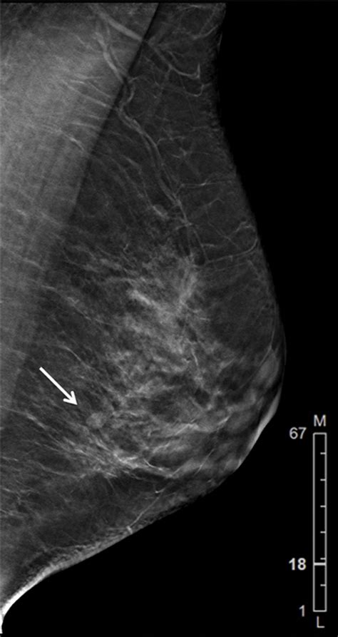 Digital Breast Tomosynthesis Concepts And Clinical Practice Radiology