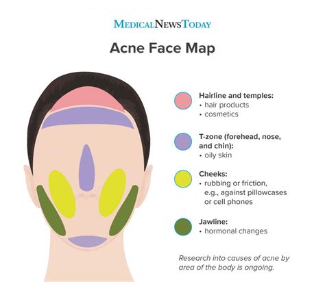 Top 14 What Does Chin Acne Mean 2022