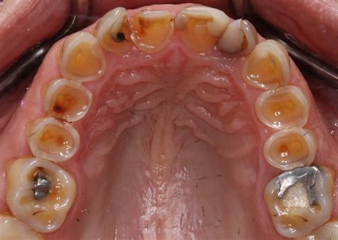 Prosthodontips Diagnosing And Treating Toothwear Dentistry Online