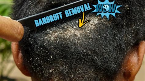 Best Huge Dandruff Removal Scratching Big Dandruff Flakes With Black