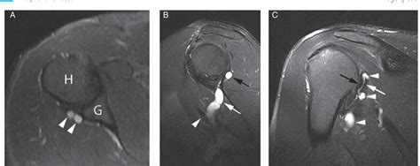 Figure 1 From Inferior Paralabral Cyst Causes Axillary Vein Thrombosis