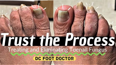 Trust The Process Treating And Eliminating Toenail Fungus Youtube