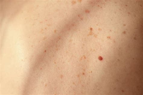 Allergic Rash Dermatitis Eczema Skin — Stock Photo