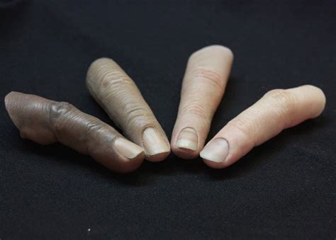 Finger Prosthetic Services Finger Extensions Fingerprosthetics Com