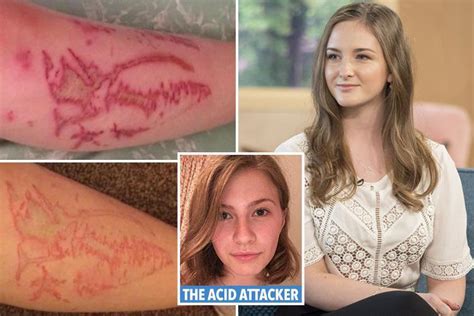 Scots Schoolgirl Acid Attack Victim Molly Young Reveals First Pictures