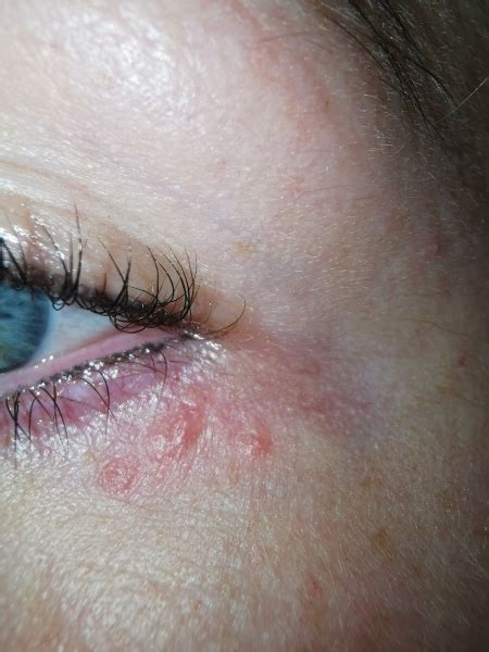 Rash Under Eye Does Anyone Know What It Is Mumsnet
