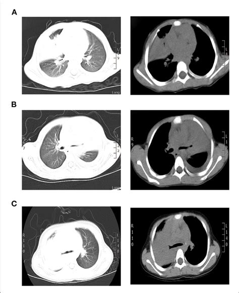 Ct Scan Findings Of Three Cases A Pulmonary Ct Results Of Case 1