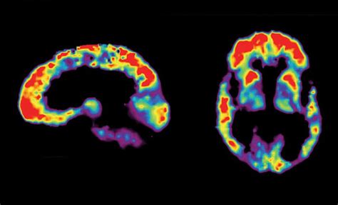 Amyloid Pet Scans Are They A Game Changer With Images Pet Scan