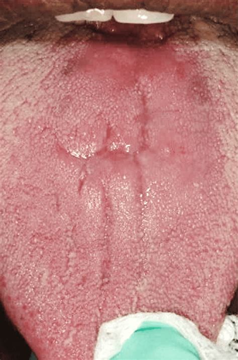 Hiv Bumps Under Tongue