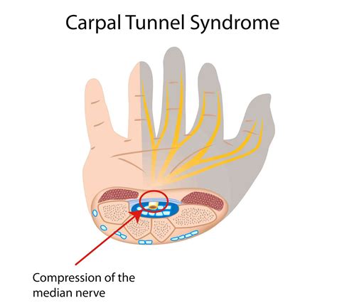 Explainer What Is Carpal Tunnel Syndrome And What Happens If I Get It