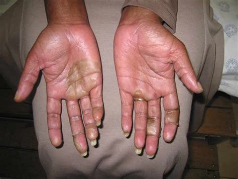 Peeling Skin Syndrome Causes Types Symptoms Diagnosis Treatment